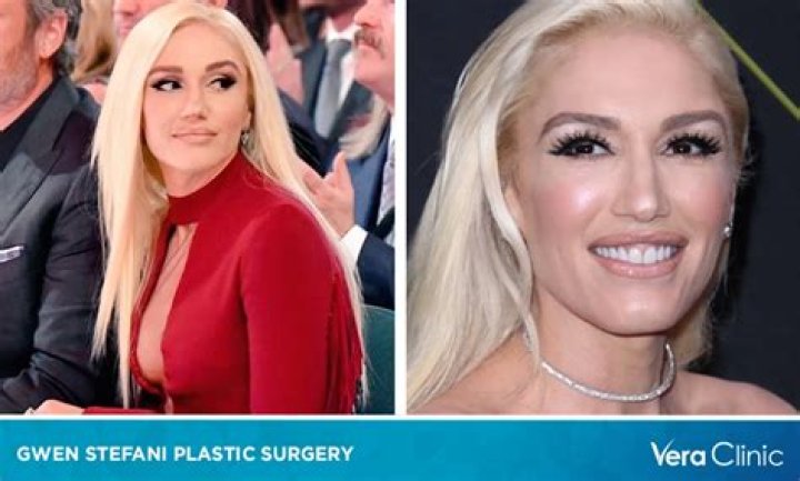 Did Gwen Stefani Undergo Plastic Surgery? Before And After Photos Fact Check