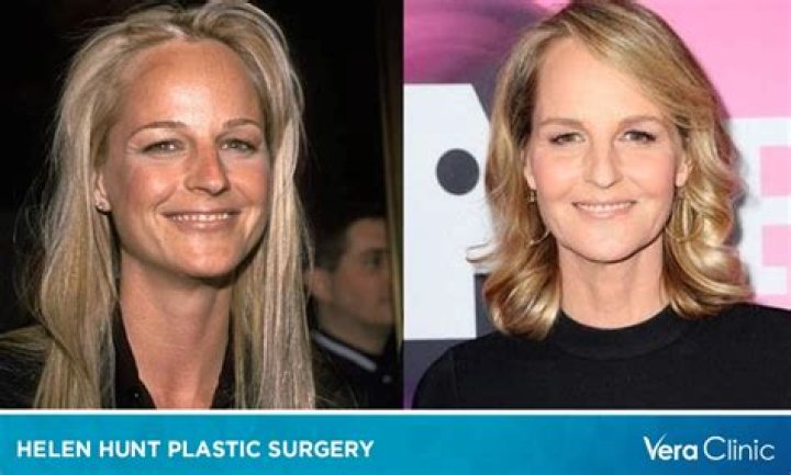 Did Helen Hunt Really Get Plastic Surgery and Botox? See Her Before and After Photos
