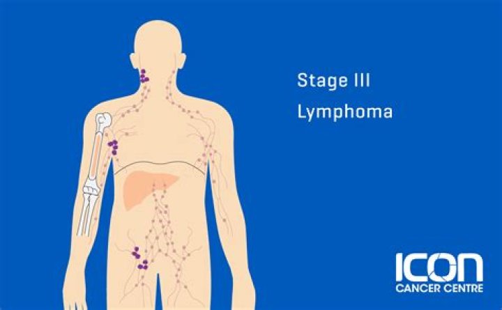 
Does Roger Stone Wife Nydia Still Have Cancer? Survived Lymphoma Stage IV 