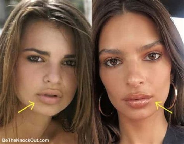 
Emily Ratajkowski Plastic Surgery – Fans Suspect Botox And Lip Filler! 