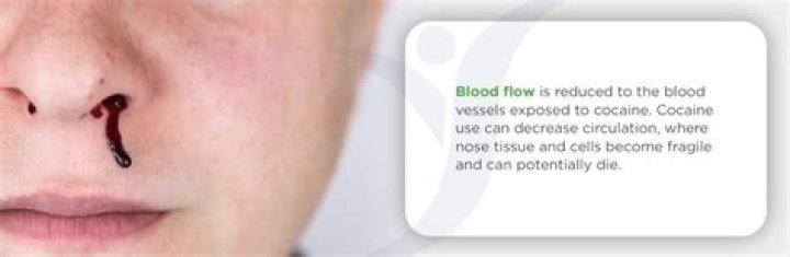 Is Matt Harvey Bloody Nose Due To Cocaine? Pitcher Admits To Drug Use In Exploding Testimony